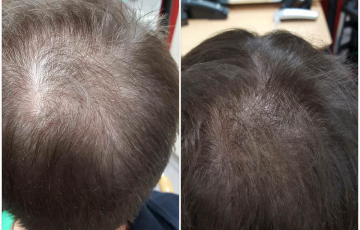 Comparison after 10 weeks of Stop & Grow application