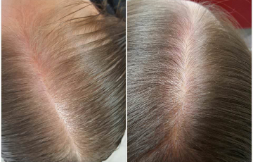 Comparison after 3 months of Stop & Grow application